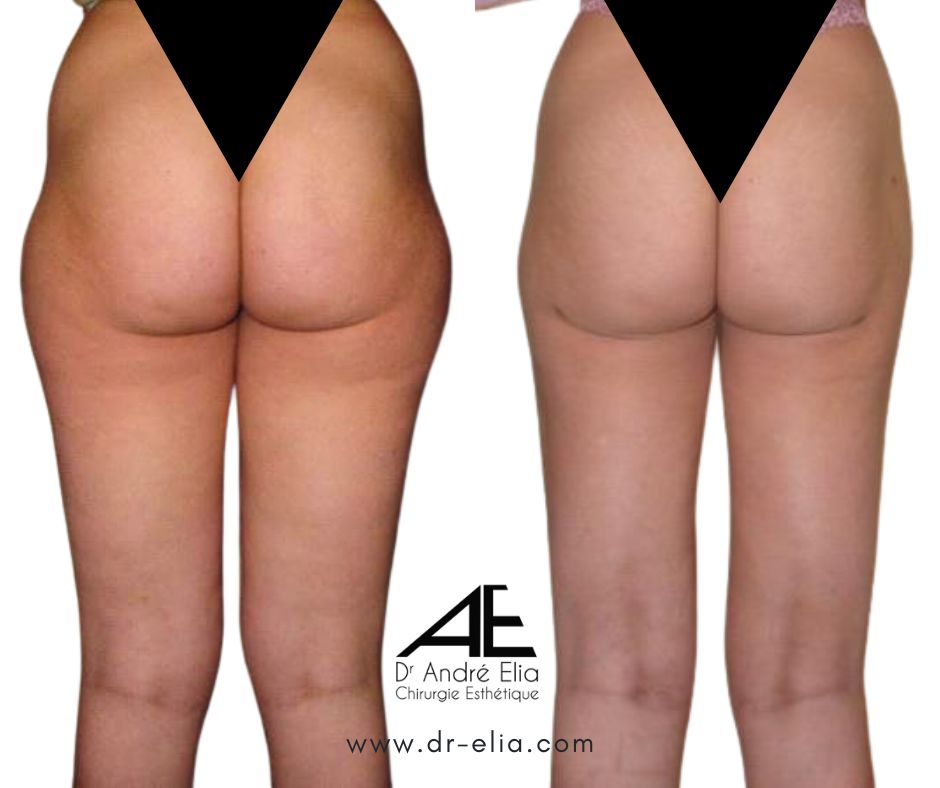 Résultat Lipoaspiration Dr Elia