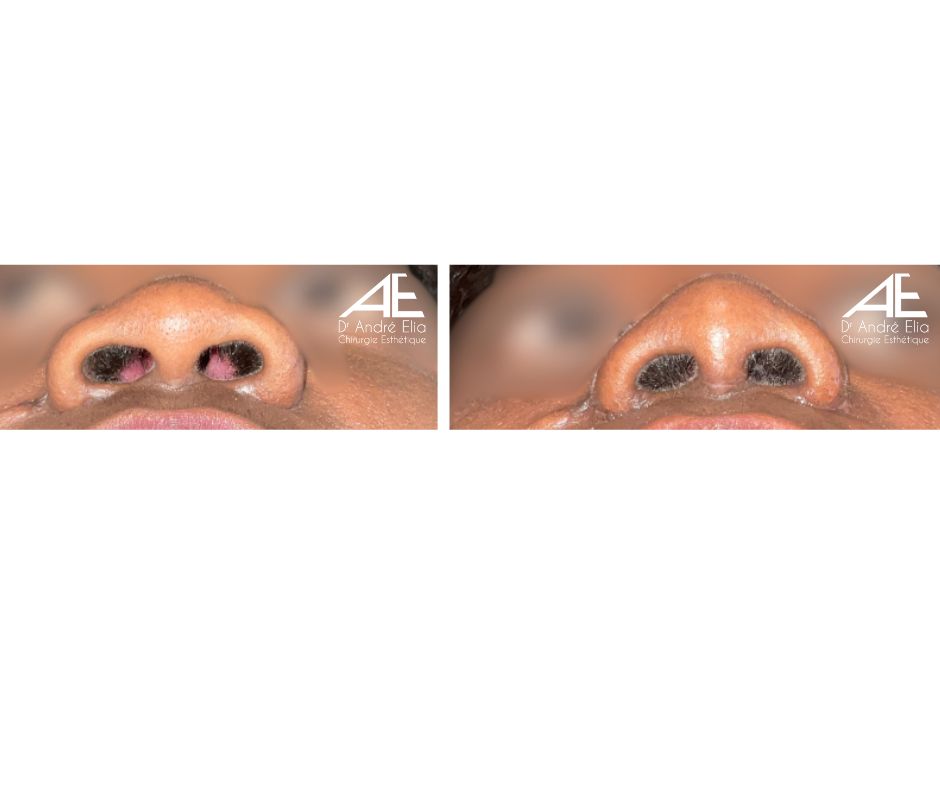 Rhinoplastie Ethnique