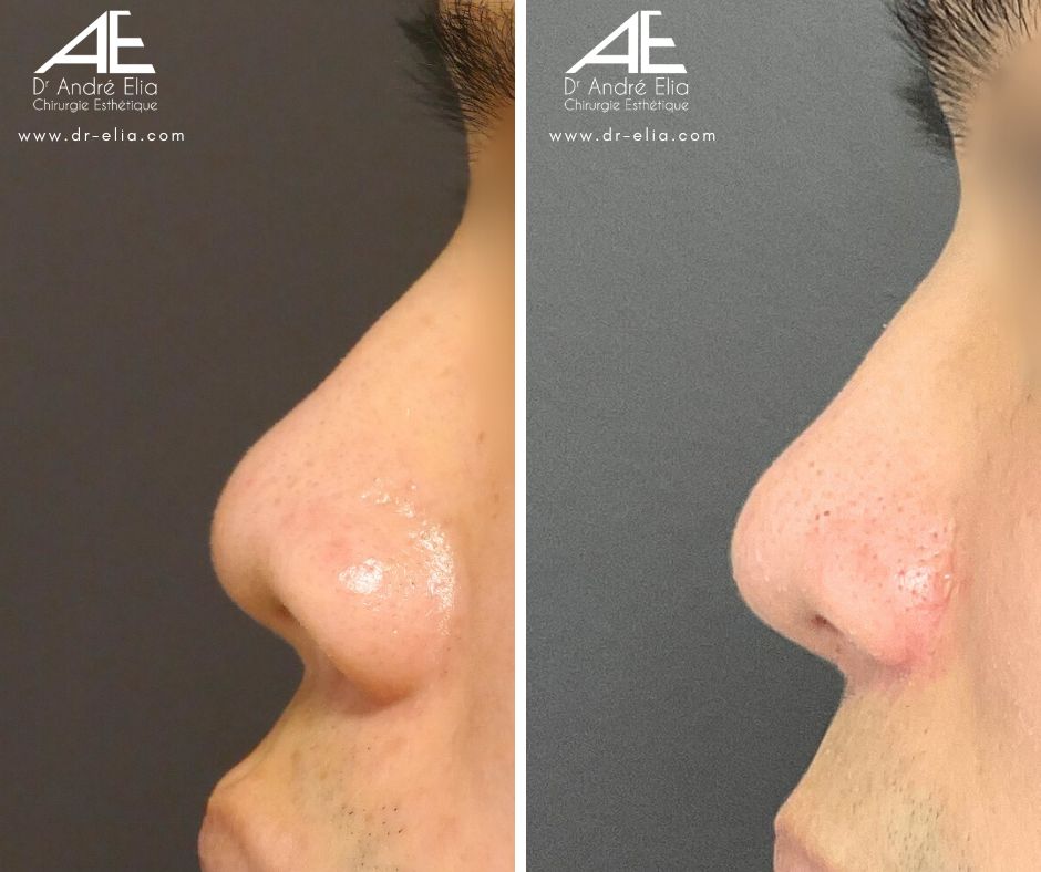 Résultat Rhinoplastie Ethnique