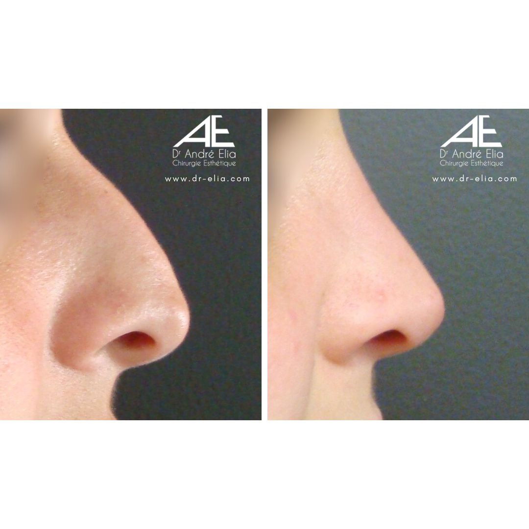 Résultat Rhinoplastie Primaire Dr Elia